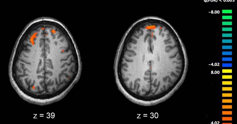 En undersøkelse oppdager at schizofreni er manifestasjonen av åtte genetiske mutasjoner