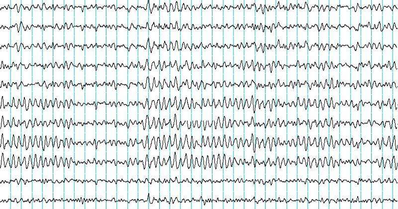Électroencéphalogramme (EEG) ce qui est et comment est utilisé?
